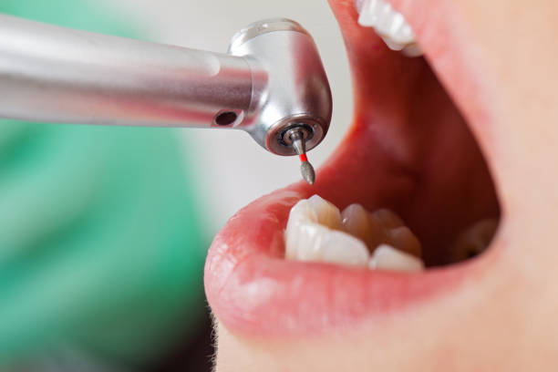Best Emergency Root Canal Treatment in Meridian Village, CO